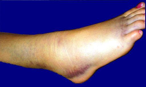 Photo of a sprained ankle