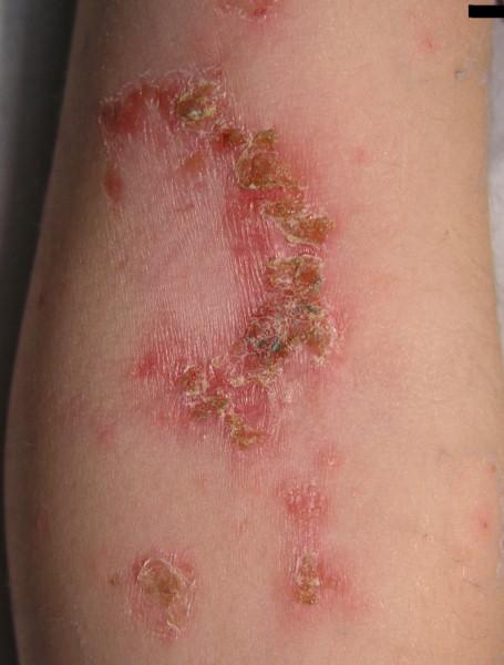 Impetigo elbow