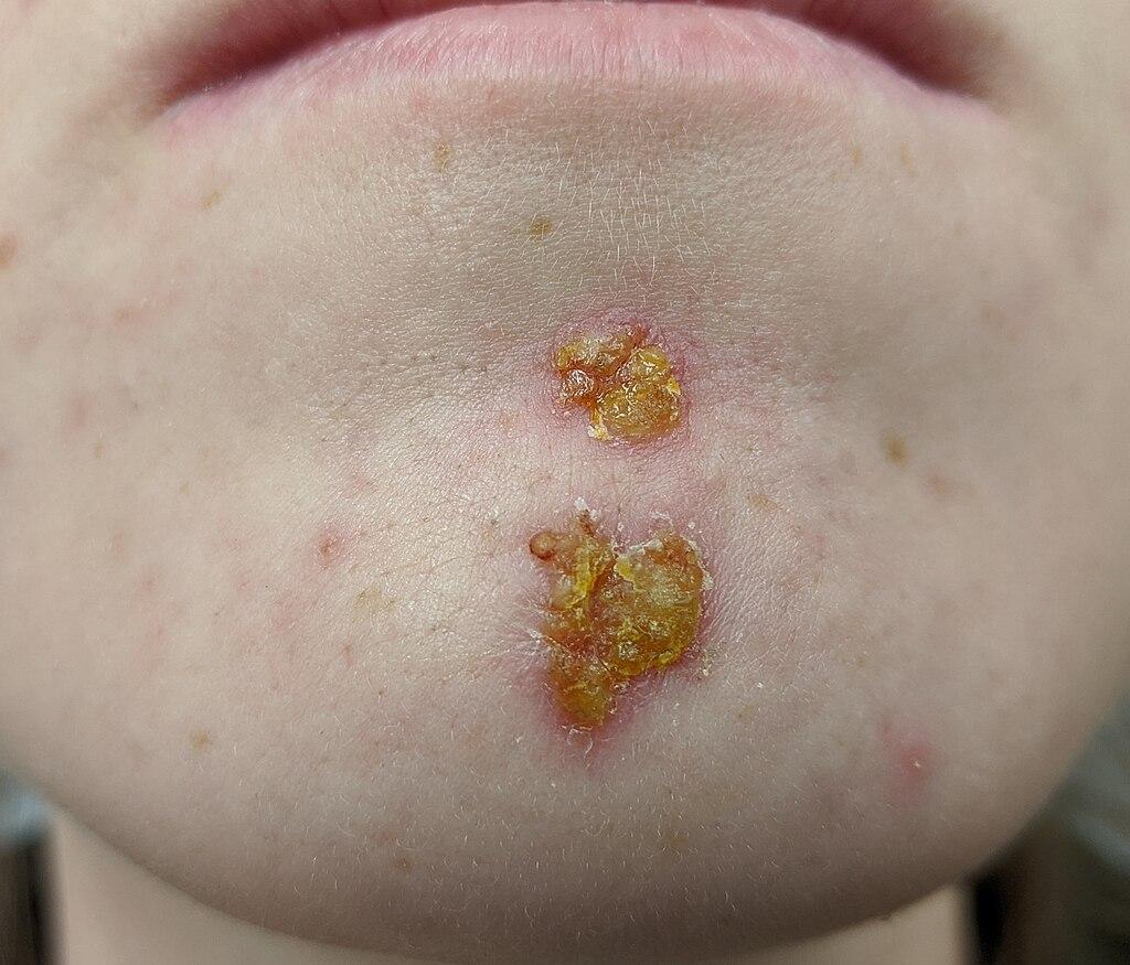 Impetigo on chin