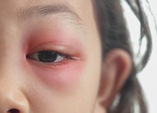 A close up of a childs eye with periorbital cellulitis