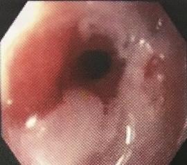 Photo of Esophageal stricture