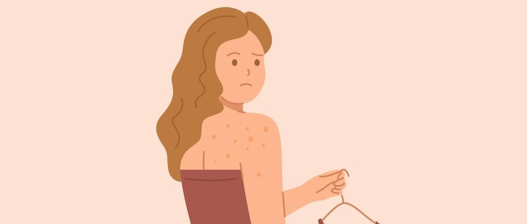 8 causes of back acne