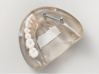 partial dentures