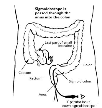 Sigmoidoscopy