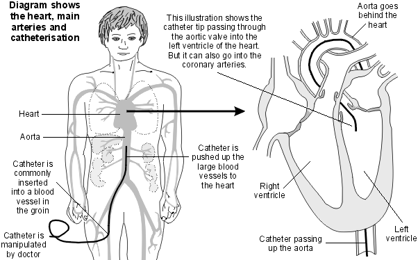 Cardiac catheterisation
