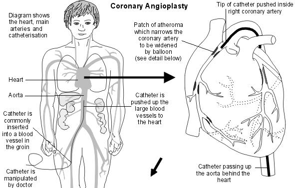Coronary angioplasty