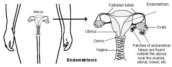 Endometriosis