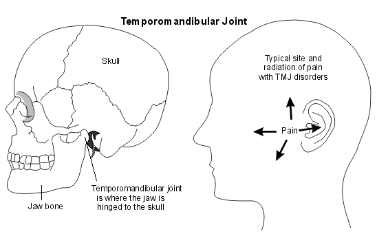 TMJ dysfunction