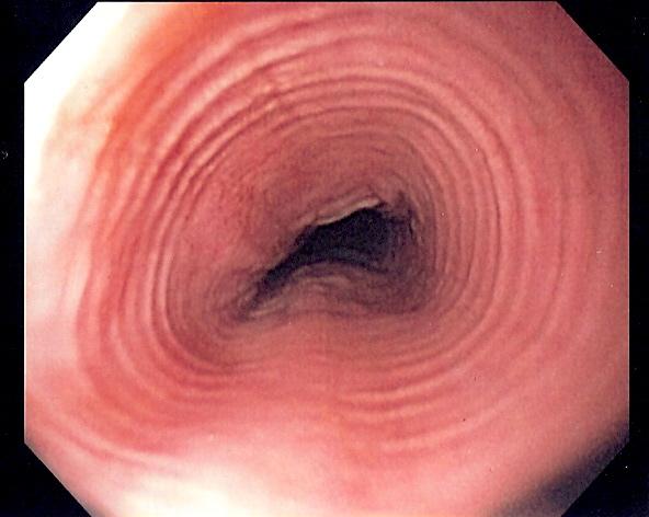 Multi-ring oesophagus