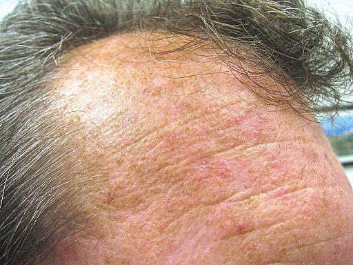 Actinic keratoses on forehead