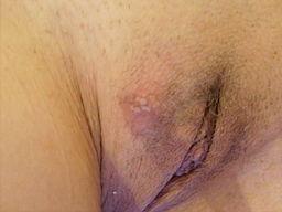 Blisters and open sores typical for genital herpes in women