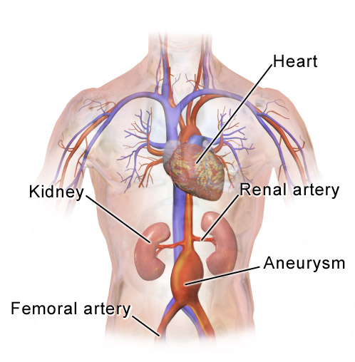 Abdominal aortic aneurysm