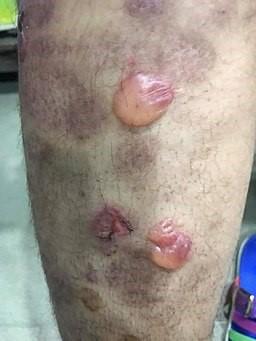Bullous pemphigoid