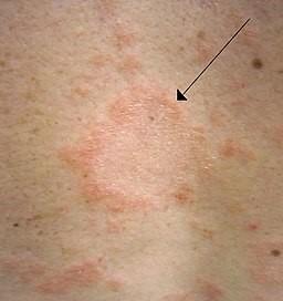 Pityriasis rosea herald