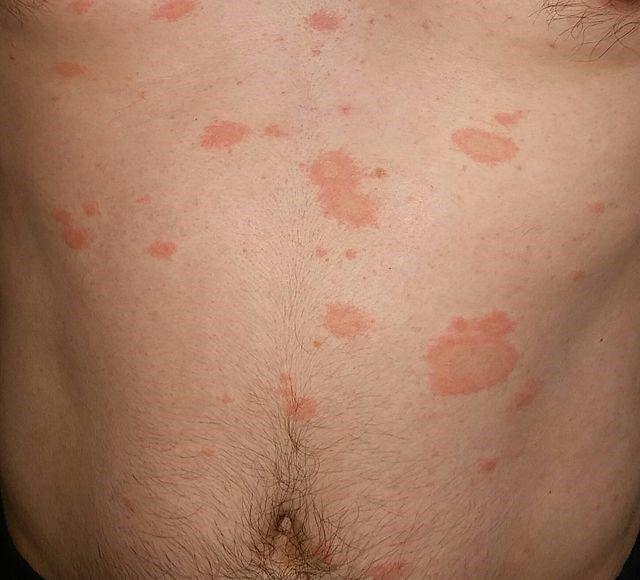 pityriasis rosea pictures