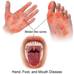 Hand, foot and mouth disease
