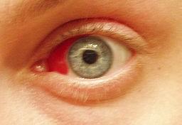 Subconjunctival haemorrhage