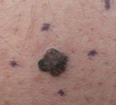 Malignant melanoma