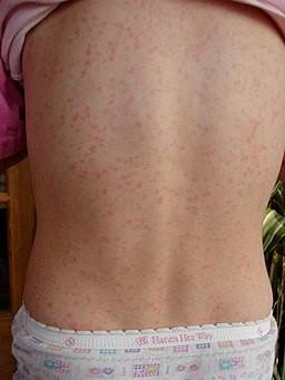 Scarlet fever rash