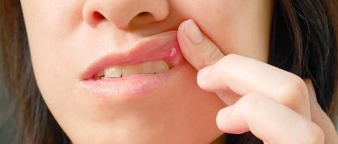 What causes mouth ulcers and how to treat them