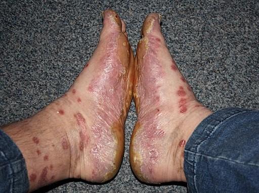 Psoriasis feet