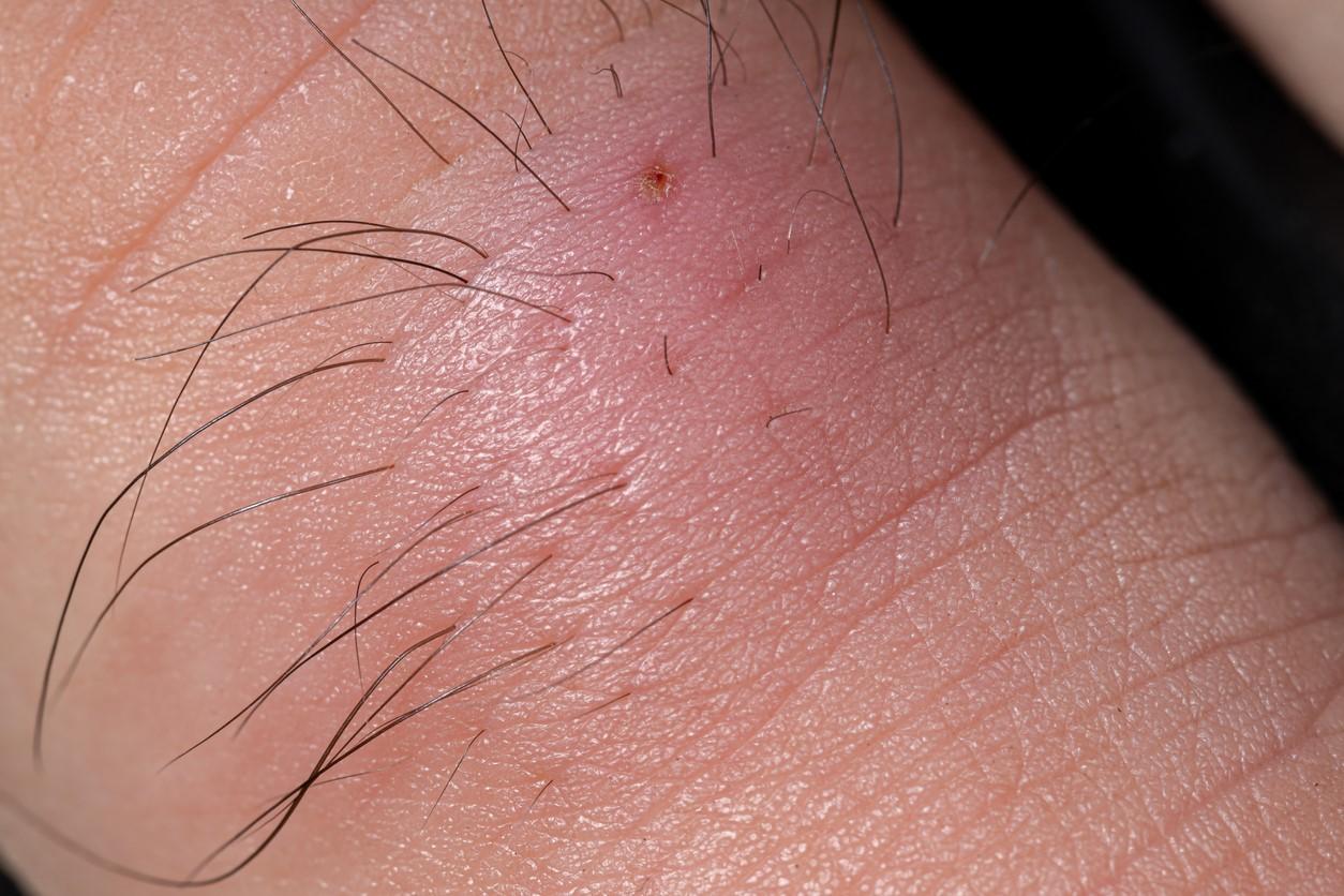 infected ingrown hair swelling and redness