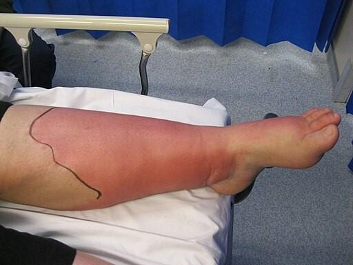 Cellulitis on leg (Wikimedia Commons)