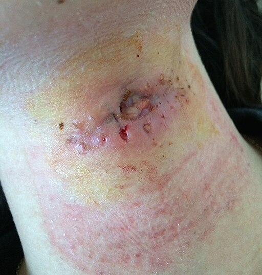 Picture of infected wounds